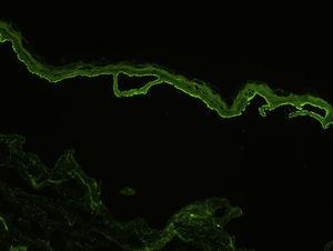Depósitos de anticuerpos anti-membrana basal circulantes en sangre periférica observados mediante inmunofluorescencia indirecta (×200), utilizando piel humana como sustrato con la técnica de salt split.