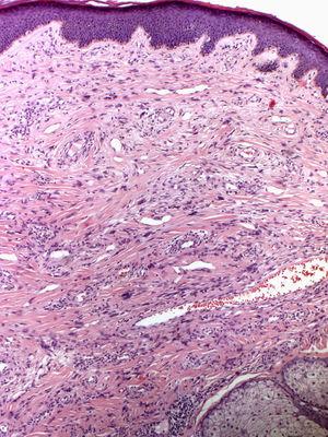 Tumoración cupuliforme formada por una proliferación dérmica de fibroblastos y vasos sanguíneos dilatados, rodeados de fibras de colágeno. Epidermis hiperqueratósica con hiperplasia melanocítica (hematoxilina-eosina ×10).