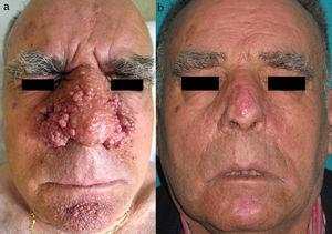 A. Paciente con angiofibromas faciales múltiples de gran tamaño. B.Resultado a los 9 meses tras tratamiento con electrocirugía.