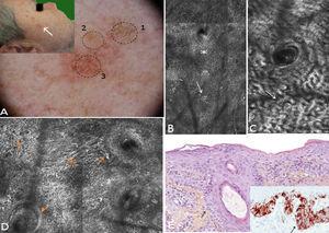 Caso 3. A. Imagen clínica y dermatoscópica donde se observa en la zona 1 pigmentación granular anular gris, en la zona 2 una pápula central y estructuras romboidales rojas incipientes en zona la 3 inferior. B. Submosaico de MCR (1000×500μm) correspondiente a la zona 1 al nivel de la epidermis, donde se aprecia un patrón en panal de abejas típico con células hiperrefráctiles aisladas sin signos de atipia. C. Submosaico de MCR (350×600μm) correspondiente a la zona 2 al nivel de la epidermis que muestra cordones epiteliales compatibles con queratosis seborreica. D. Submosaico de MCR (800×900μm) correspondiente a la zona 3 al nivel de la epidermis que muestra panal de abejas desestructurado, () refuerzo perifolicular, () así como múltiples células dendríticas () y pagetoides dendríticas () cerca de las salidas foliculares. E. Imagen histológica (H-E y HMB 45×10 de magnificación) que muestra epidermis de estructura lentiginosa, con nidos de melanocitos atípicos en la capa basal epidérmica y en los folículos (↓).