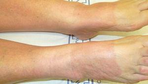 Lesiones maculosas eritematosas que afectan a las piernas y al dorso de los pies de una paciente con fotosensibilidad por hidroclorotiazida. Obsérvese el límite neto con la piel sana que estaba cubierta por el zapato.