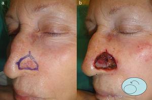 A y B. Carcinoma basocelular recidivado en el ala nasal y defecto quirúrgico resultante tras 2 etapas de cirugía de Mohs con esquema de la rotación del colgajo mio-condro-mucoso del ala adyacente.