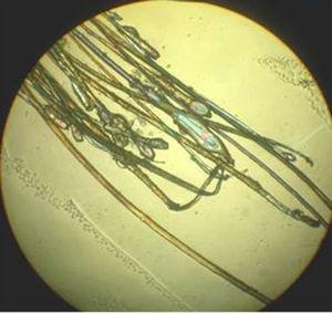 Alopecia telogénica: más del 20% de los cabellos en fase de telogén. Microscopio optico de luz polarizada (x10).
