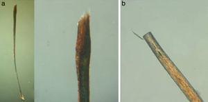 Observación del extremo distal. A. En pincel (alopecia areata). B. Cortado (tricotilomanía). Microscopio optico de luz polarizada (x10-x40).