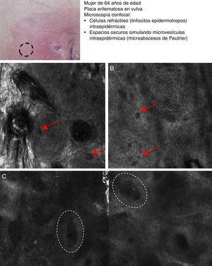 Presentación clínica de lesión de enfermedad de Paget extramamaria. A. Imagen (0,5×0,5mm) superficial (estrato córneo/estrato granuloso) donde se aprecia la «infiltración pagetoide» por unas células de baja refractilidad, oscuras (flechas). B. Imagen (0,5×0,5mm) del estrato espinoso que revela la infiltración de células pagetoides (flechas) de gran tamaño que duplica o triplica los queratinocitos circundantes y que altera la arquitectura normal en «panal de abejas». C. Submosaico (1×0,5mm) en la unión dermoepidérmica que demuestra borramiento de los anillos (círculos discontinuos) en cuyo interior se observa infiltrado inflamatorio.