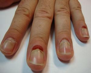 Granulomas piogénicos en el pliegue ungueal proximal de las uñas del segundo y cuarto dedo de la mano derecha y desprendimiento de las uñas del segundo al quinto dedo.