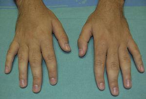 Engrosamiento bilateral y simétrico de la cara lateral de las articulaciones interfalángicas proximales de los dedos 2.° al 5.° de ambas manos.