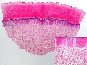 Histológicamente se observa una dermis engrosada a expensas del engrosamiento de los haces de colágeno, junto con un ligero aumento del número de fibroblastos, sin inflamación. La epidermis muestra hiperqueratosis ortoqueratósica y acantosis (hematoxilina-eosina ×5). En el recuadro de la derecha se muestra a mayor detalle el aumento de los haces de colágeno y de los fibroblastos (hematoxilina-eosina ×20).