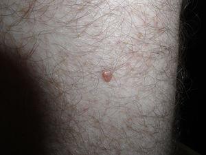 Lesión papular, del color de la piel, en el muslo izquierdo.