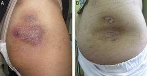 Lesión en el glúteo al mes (A) y a los 8 meses (B) de iniciar tratamiento con ustekinumab.