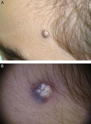 A. Lesión nodular subcutánea de consistencia firme con pigmentación en la piel suprayacente y áreas blanquecinas en la región frontotemporal izquierda. B. Imagen dermatoscópica.
