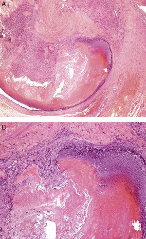 Tumor bien delimitado en el que se aprecia la mezcla del componente epitelial de células basaloides y las «células sombra» en el centro de la lesión, y un componente periférico mesenquimal formado por células fibroblásticas. A. H-E ×40. B. H-E ×100.