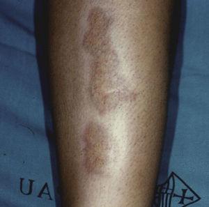 Necrobiosis lipoidea localizada en cara anterior de la pierna.