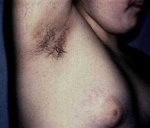 Acantosis nigricans, placa hiperpigmentada de superficie aterciopelada en la axila de una adolescente, quien además presenta estrías violáceas en el seno.