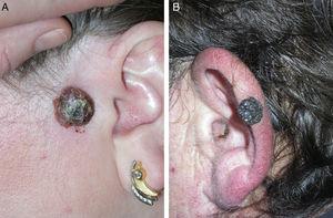 A. Mujer de 45 años que presenta tumor de 2cm de diámetro localizado en la región preauricular izquierda. Evolución: 2 años. B. Varón de 50 años que presenta esta lesión exofílitica verrucosa de 1,5cm localizada en oreja izquierda. Evolución: entre 1 y 2 años.