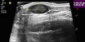 Imagen típica de un quiste epidérmico: lesión hipoecoica con refuerzo central posterior y sombras laterales. El doppler no mostró vascularización en el interior del quiste.
