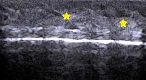 Pelo: corte longitudinal en el cuero cabelludo. Las estrellas corresponden al folículo pilosebáceo en la región del bulbo.