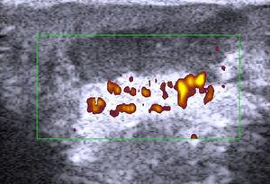 Hidrosadenitis. Área hipoecoica irregular en la unión dermosubdérmica con aumento de flujo perilesional.