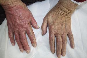 Eritema y descamación extensa en dorso de la mano derecha.