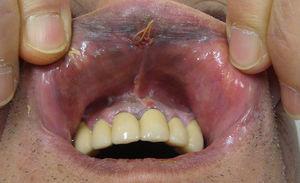 Melanoma de mucosa oral.
