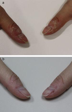 A. Verrugas periungueales en algunos de los dedos afectados de forma previa al tratamiento. B. Resolución de las lesiones tras el tratamiento.