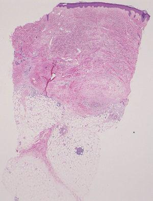 Histological features included thickened collagen bundles in the dermis, fibrosis of septal tissues, and patchy lymphocytic infiltrates in the subcutaneous tissues.