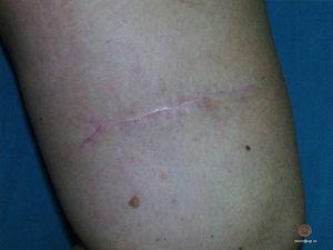 Cicatriz de extirpación de un melanoma en cara anterior del muslo derecho (mismo caso presentado en el video). Dos años después de realizar sutura oblicua subcutánea.