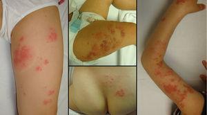 Características clínicas de las lesiones de herpes zóster presentadas por 4 de nuestros pacientes.