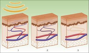 Mecanismo de acción de la luz pulsada intensa en las lesiones vasculares. La hemoglobina capta la energía (1), se produce la coagulación del vaso (2) y posterior destrucción (3).