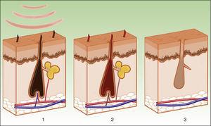Mecanismo de acción de la luz pulsada intensa en la fotodepilación. La melanina del tallo piloso y las células madre de la papila dérmica actúan como cromóforos (1), la energía se transforma en energía térmica (2), causando la necrosis del bulbo piloso (3).