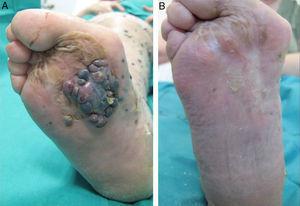 A. Melanoma nodular plantar de gran tamaño con múltiples metástasis cutáneas siguiendo el trayecto de la pierna. B. Resolución del tumor un año después del tratamiento con electroquimioterapia.