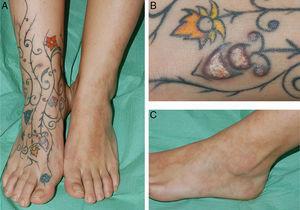 Lesión número 2 (A), mostrando erosiones y salida de material en las zonas rojas de un tatuaje multicolor en el dorso del pie derecho (B), mientras que en dorso del pie izquierdo se observan lesiones de granuloma anular (C).