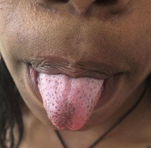 Múltiples papilas fungiformes marrones localizadas en la punta y en los bordes laterales de la lengua.