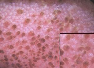 En la dermatoscopia se observan múltiples proyecciones de bordes pigmentados atravesados por vasos que se bifurcan desde su base, aspecto semejante a «pétalos de rosa».