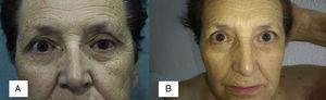 A) En el ojo izquierdo se aprecia miosis de la pupila, ptosis del párpado superior y una mayor sequedad en la piel (tríada característica del síndrome de Horner). B) Resolución de las alteraciones citadas previamente