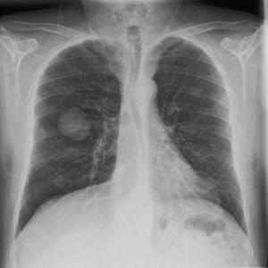 Radiografía de tórax con masa de 4cm en el lóbulo inferior del pulmón derecho.