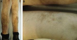 A. Imagen clínica. Afectación simétrica de ambas piernas con hiperpigmentación. B. Imagen clínica. Nódulos subcutáneos, de consistencia dura, bien delimitados, sobre los cuales se aprecian máculas eritemato-parduzcas con patrón reticular.