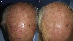 Varón con múltiples queratosis actínicas y campo de cancerización en el cuero cabelludo (A) antes y (B) 3 meses después de TFDLD con MAL.