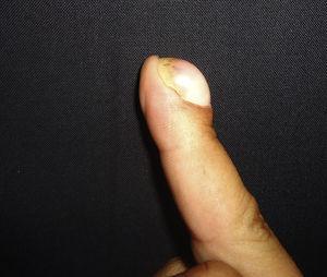 Deformidad de la lámina ungueal tanto en su eje longitudinal como transversal afectando al tercer dedo de la mano derecha.