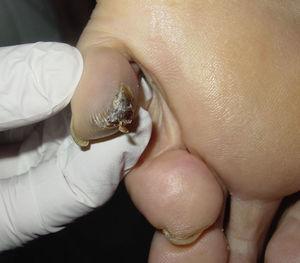 Imagen del tumor primario en el paciente con metástasis ganglionares de melanoma en la región inguinal izquierda. Se aprecia una lesión pigmentada oscura y queratósica de 1,5×1cm, con signo de Hutchinson, en el pulpejo del quinto dedo del pie izquierdo.