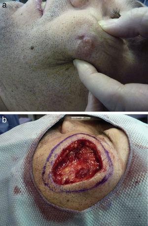 a. Imagen clínica de la lesión. Tumor con superficie rosada y extensión a planos profundos, de 3×2,5cm en la mejilla izquierda. b. Imagen clínica. Extirpación del tumor y diseño del primer pase de cirugía de Mohs (5mm).