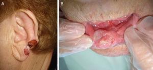 Imágenes clínicas de CEC en localizaciones consideradas de «alto riesgo»: pabellón auricular (A) y labio inferior (B).