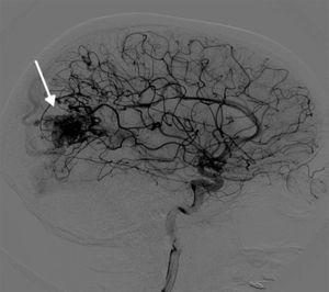 Imagen de angiografía diagnóstica previa a la intervención, en la que se observa una malformación arterio-venosa de gran tamaño en la región occipital izquierda (flecha).