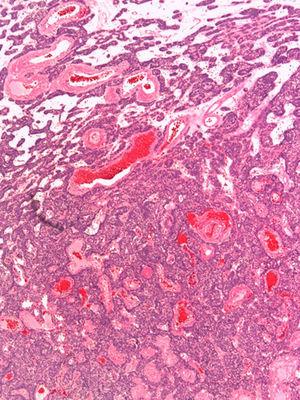 Patrón organoide de nidos celulares unos con núcleo hipercromático de aspecto basaloide junto con células de citoplasma amplio y claro separados por tractos fibrosos en los que se encuentran abundantes estructuras vasculares dilatadas y congestivas (HEx10).