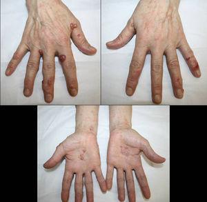 Lesiones vesiculosas y ampollosas de contenido serohemático en el dorso y las palmas de manos, con algunas zonas erosivas y placas eritematosas descamativas en muñecas.
