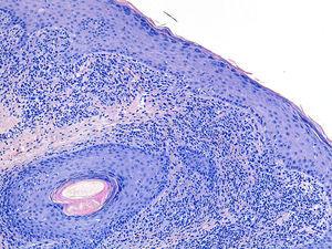 Degeneración hidrópica de la capa basal epidérmica, presencia de melanófagos e infiltrado linfohistiocitario en la dermis papilar superficial (hematoxilina-eosina X 4).