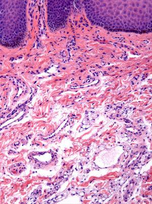 Partial view of epidermal acanthosis, papillomatosis, and basal hyperpigmentation. Scattered aggregates of immature fat cells are seen in the submucosa (hematoxylin and eosin, original magnification ×100).