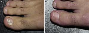 Onicomicosis blanca superficial por Fusarium oxysporum. Antes (A) y 48 semanas después (B) de tratamiento con 3 sesiones, separadas por una semana de terapia fotodinámica con metilaminolevulinato al 16% y Aktilite (Photocure ASA, Oslo, Noruega; 37J/cm2). Antes de cada sesión se realizó preparación con urea al 40% en oclusiva las 3 noches previas, y eliminación mecánica activa de lámina ungueal justo antes de la aplicación del fotosensibilizante.