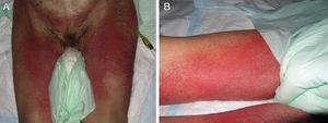 A y B. Lesiones de una pustulosis exantemática generalizada aguda en relación con levofloxacino.