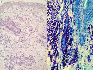 Mastocitosis cutánea estudio histológico. A. Infiltrado mastocitario perivascular en dermis (HEx100). B. Gránulos metacromáticos en el citoplasma (azul de toluidinax200).